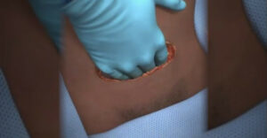 Vieš ako prebieha cisársky rez? Názorná animácia ti rozšíri obzory