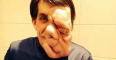 Myslel, že zomrie sám a nemilovaný. Opak bol pravdou a znetvoreného muža si našla láska ako z rozprávky