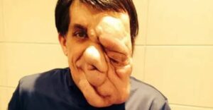 Myslel, že zomrie sám a nemilovaný. Opak bol pravdou a znetvoreného muža si našla láska ako z rozprávky
